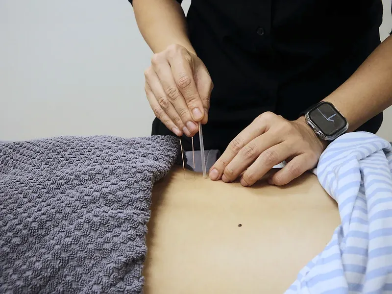 Close-up of dry needling applied along the lower back